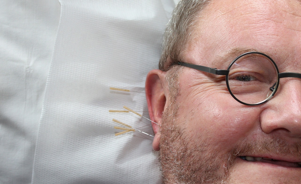 10 Surprising Benefits of Acupuncture Revealed