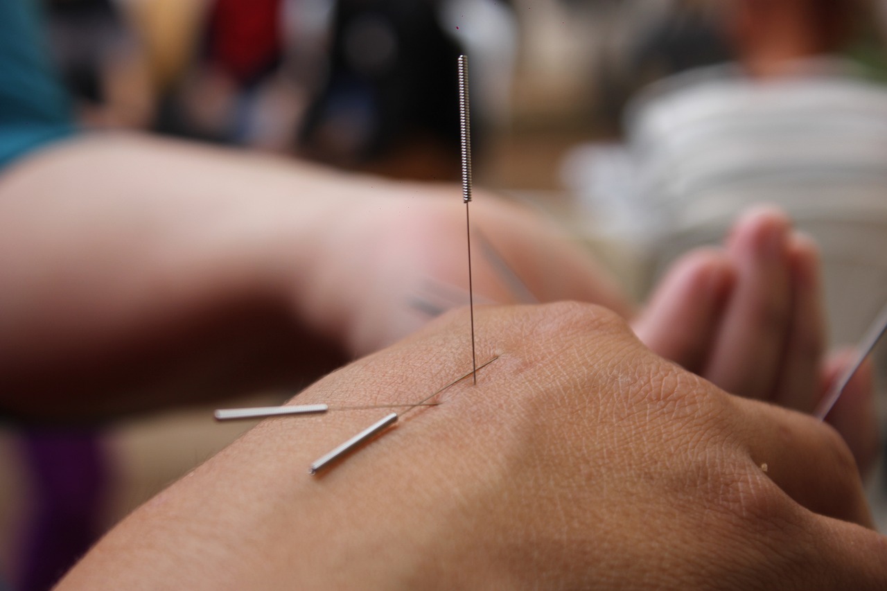 The Many Faces of Acupuncture: Exploring Different Techniques