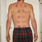 Discover the Ancient Chinese Wisdom of Acupuncture