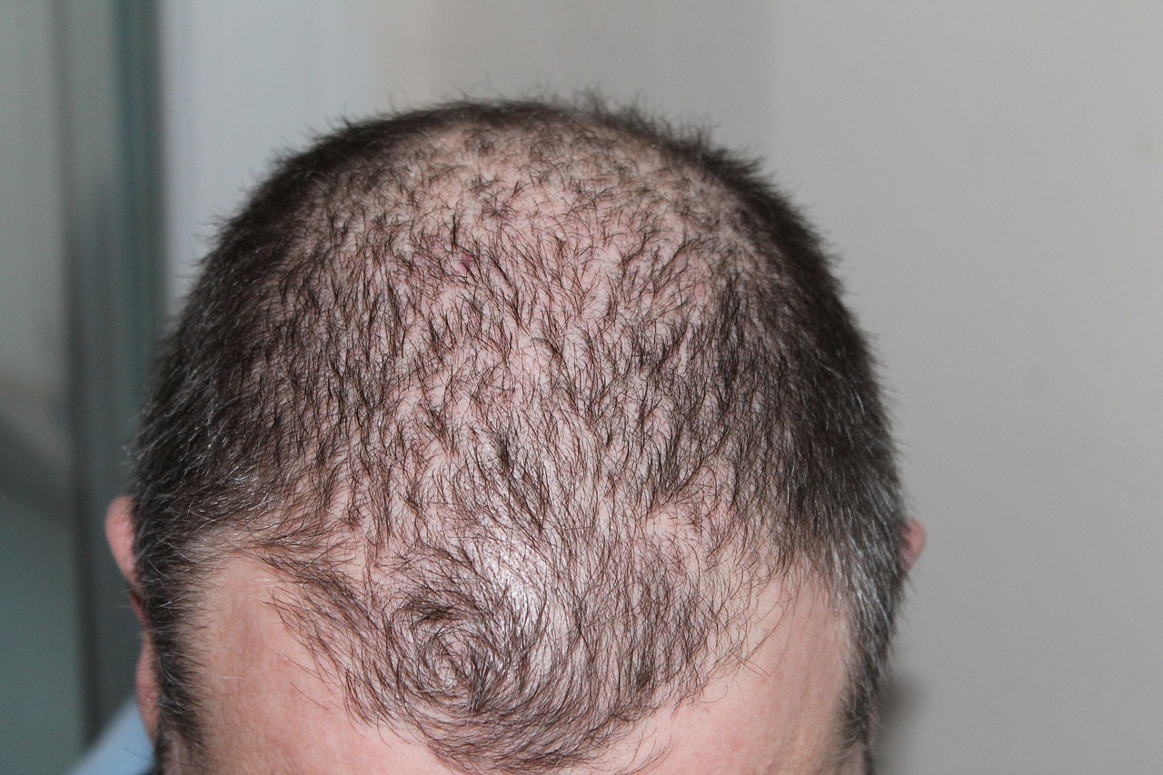 Hair Loss in Men: Understanding Male Pattern Baldness
