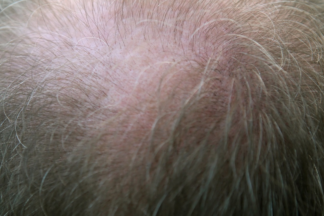 Hair Loss as a Symptom: Unveiling Underlying Health Issues