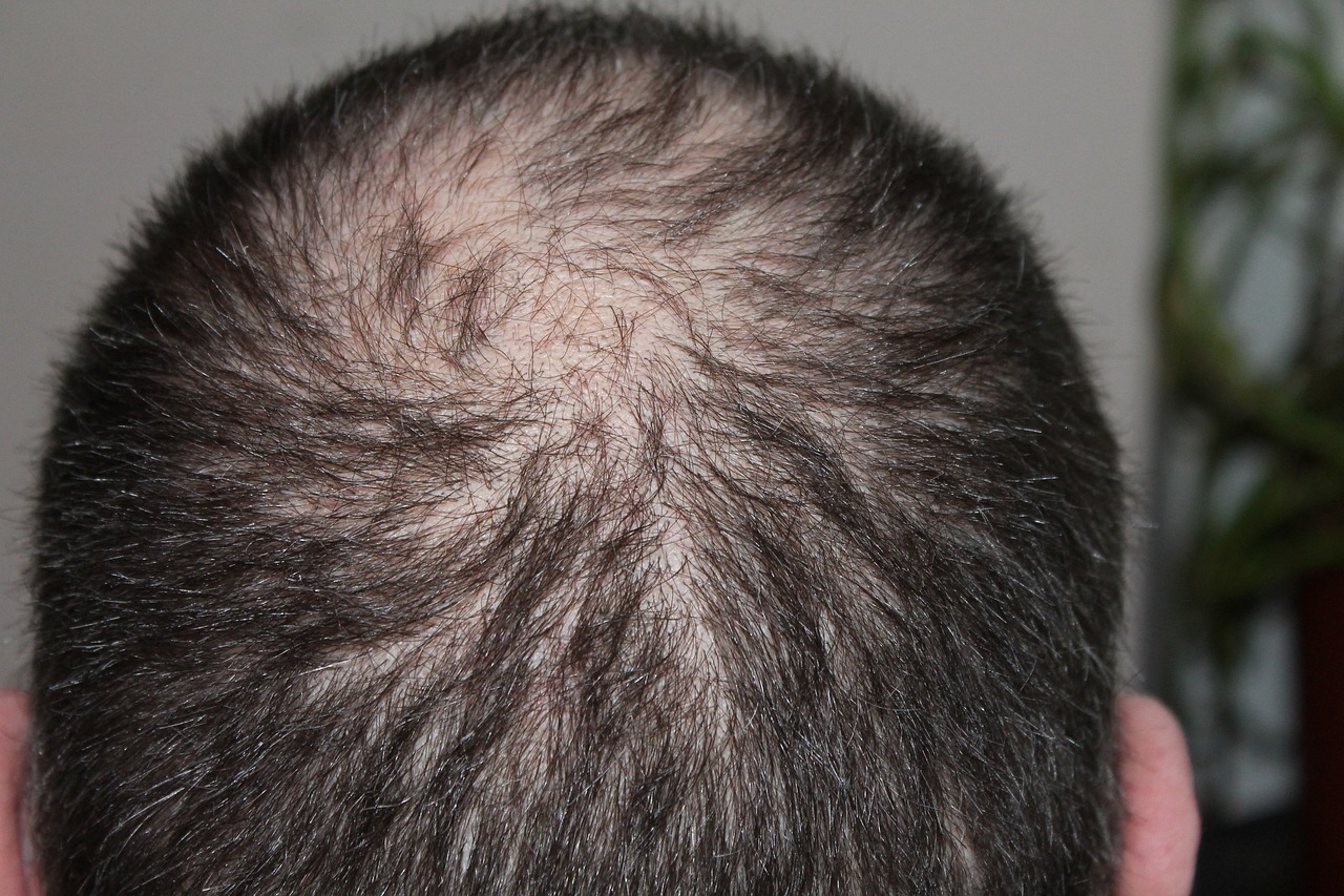 The Surprising Effects of Hair Loss on Mental Health