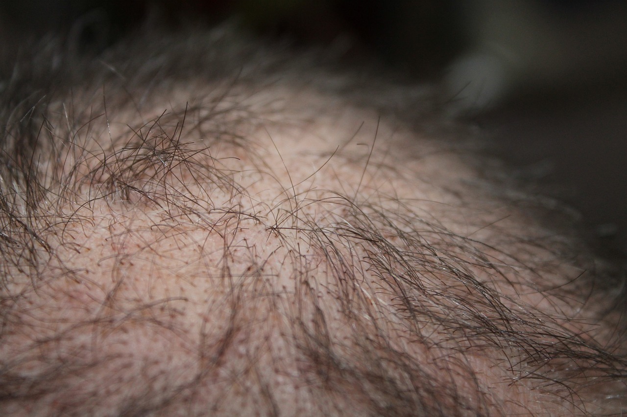 Hair Loss: Accepting the Unchangeable, Changing the Rest